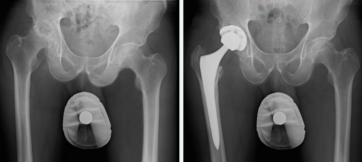 Total Hip Replacement Surgery (Hip Prosthesis)