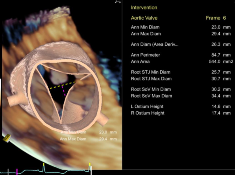 TEE Sizing for TAVR - Physician Resource