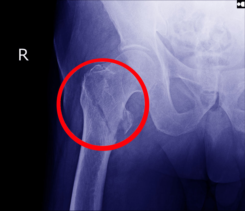 UVA Health Is Setting The Standard Of Care For Geriatric Hip Fractures