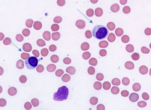 Large granular lymphocytes are medium sized cells containing abundant granular cytoplasm