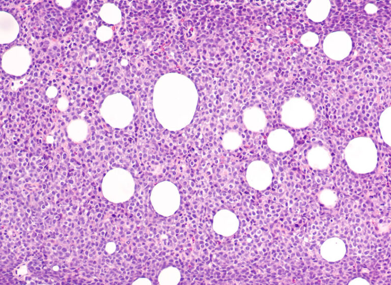 non-hodgkin large b cell lymphoma