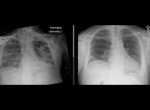 Chest X-ray pre and post COVID-related lung transplant