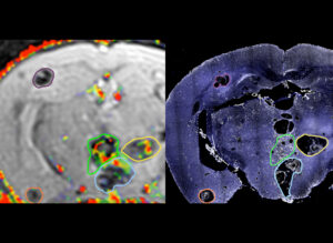 At left, a T2-weighted MRI with T1-map of gadolinium concentrations on vascular lesions in a live mouse shows blood-brain barrier permeability of cavernomas from low (blue) to high (red). At right, a histological section from the same mouse with nuclear stain DAPI (blue) and CD31 antibody labeling endothelial cells in the blood vessels (white). Corresponding vascular lesions between the images are encircled with the same color.