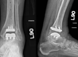 X-rays after ankle replacement
