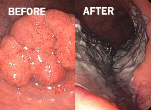 Before and after endoscopic submucosal dissection on rectal adenoma