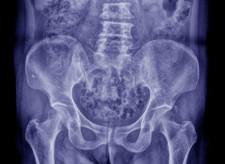 An X-ray shows a child's broken hip bone