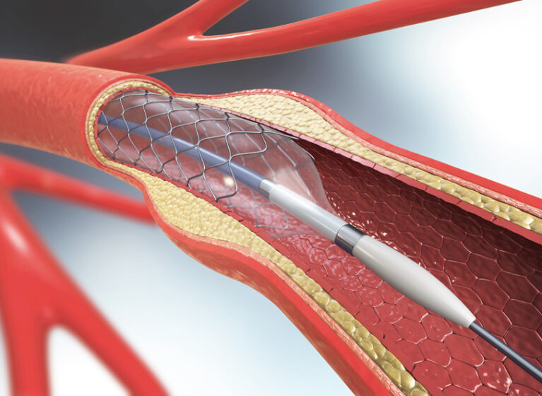 A new procedure to prevent in-stent restenosis