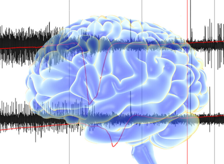 recording of spreading depolarizations overlayed on image of brain