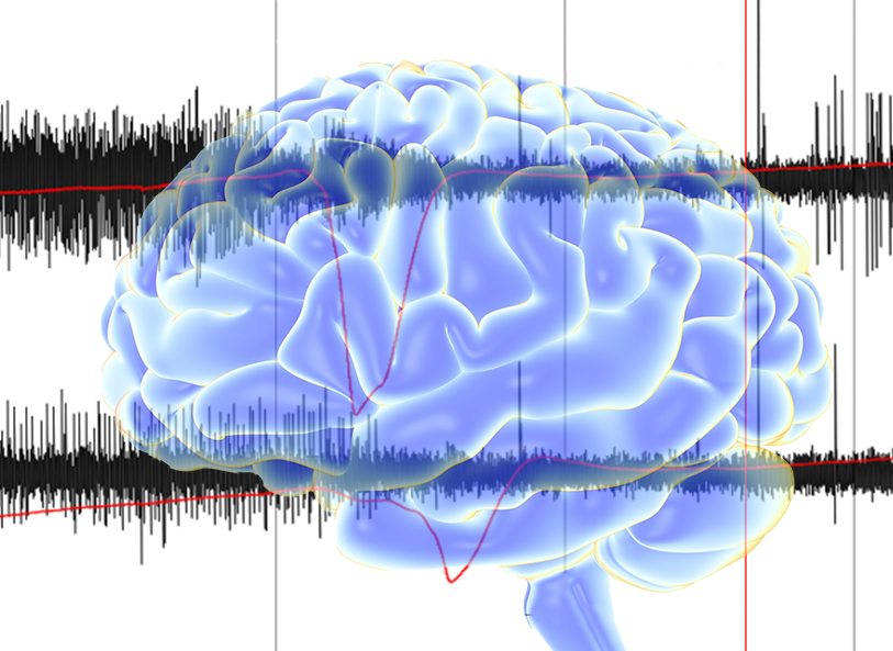 Researching Ways to Reduce Secondary Injury After Large Strokes