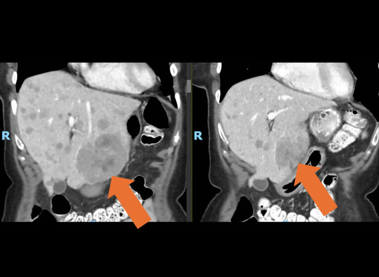 Imaging showing hepatic tumor size prior to and 6 weeks after treatment