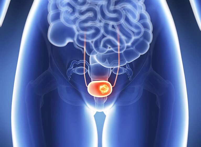 3D illustration of bladder cancer