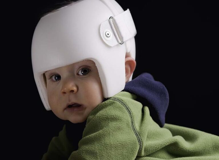A seven month old baby wearing a helmet or